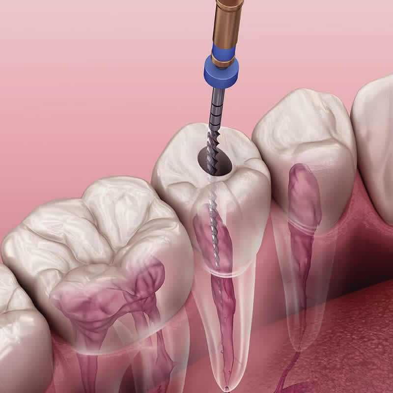 Endodontia Núcleo de Odontologia e Saúde